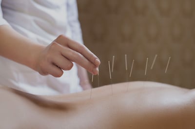 Acupuncture