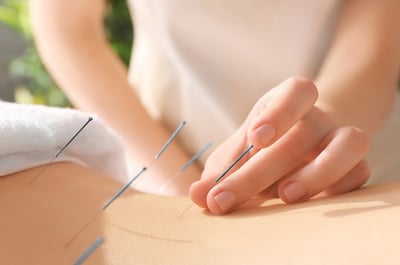 Acupuncture at Vitalica Wellness